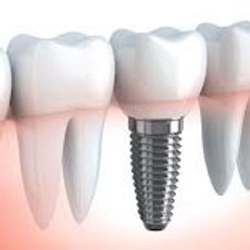 Nadgradnje na implantatih